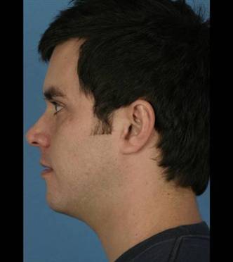 34 yo ml sp SAL TPP before.jpg