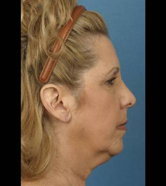 57 yo fm sp ant FL SMAS plication SAL TPP before profile.jpg