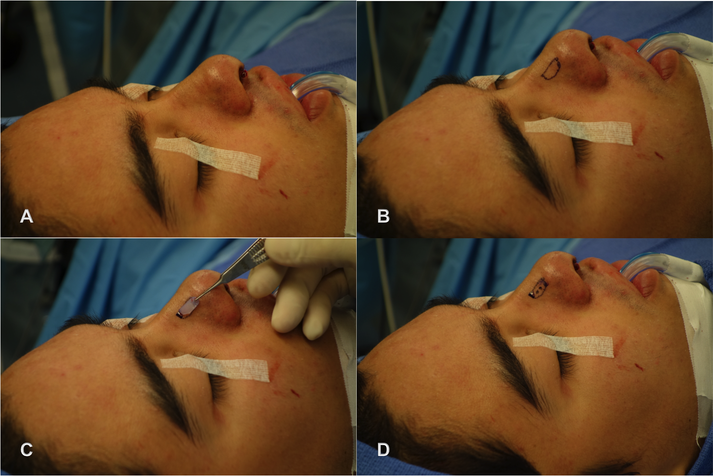 Description: Butz:Users:Butz:Dropbox:Current Projects:Nasal Onlay Graft:A-D pics.png